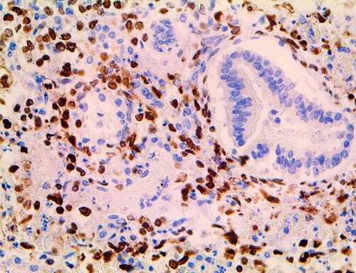 IHC of HSV I & II on a FFPE Infected Tissue